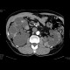 Polycystosis of kidney and liver: CT - Computed tomography
